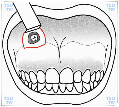 位于上颌窦内异位阻生智齿的拔除