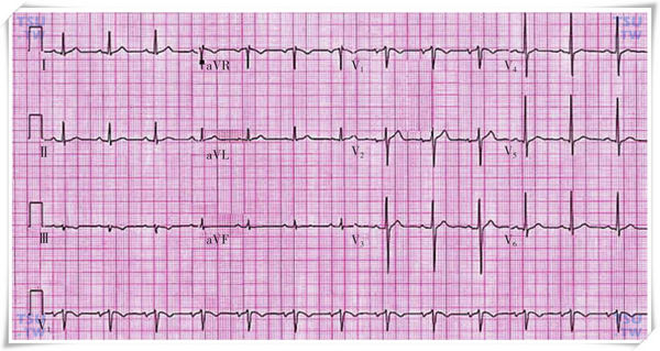  正常心电图