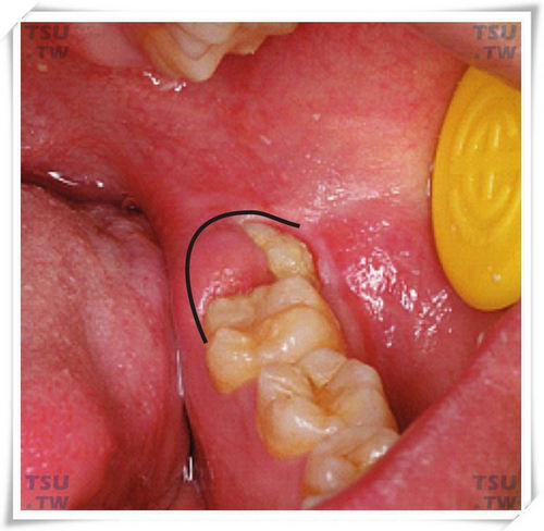  智齿龈切术示意图