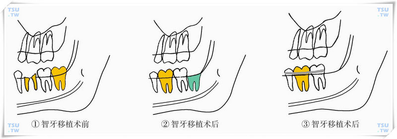 智齿、磨牙移植术