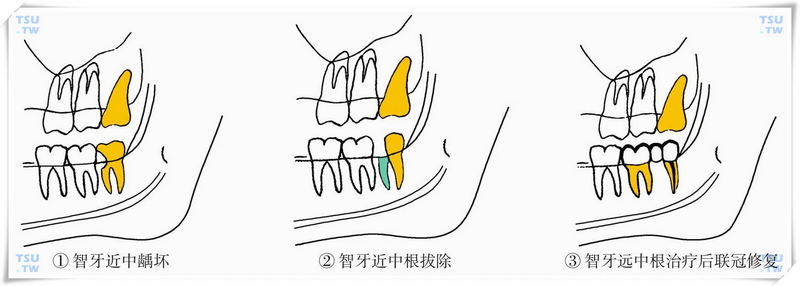  智齿半保留术