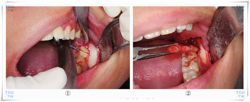 智齿微创拔牙：涡轮分根和取根