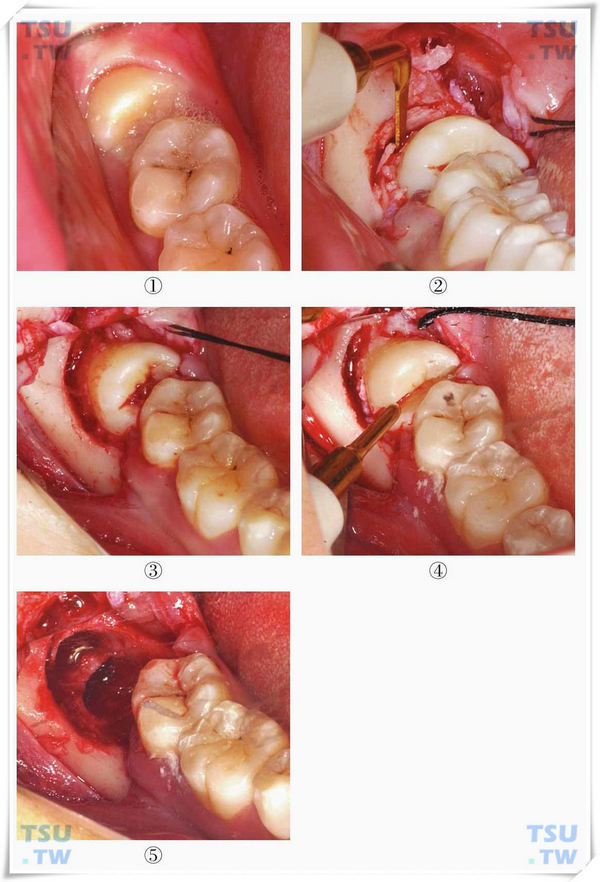 拔智齿痊愈的过程图解图片