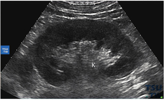 正常肾超声图像： 肾脏自外向内依次为肾被膜轮廓线，中等回声略偏低的肾皮质，回声低暗均质的髓质锥体，中心为肾窦，是回声偏强的肾盂肾盏结构。肾实质C形包绕肾脏，内侧缘为凹面，凹面中部为肾门。肾动脉、肾静脉、淋巴管和神经由此通过，也是肾盂与输尿管连接的重要部位。因此在超声检查过程中肾门是需要观察的重要部位之一。（K：肾）