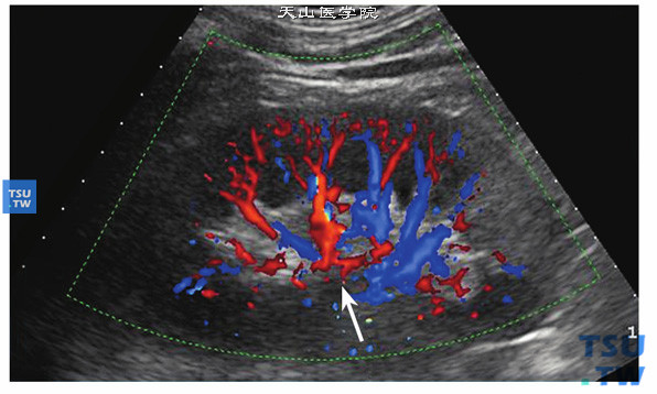 正常肾血流超声图像：箭头为肾门部，红蓝信号提示两条主干血管肾动脉及肾静脉，肾动脉自腹主动脉发出自肾门部进入肾内，血流自肾门至肾皮质呈“树枝”状分布，血管由粗变细向远端逐渐分支。肾静脉位于肾动脉前侧平行走向，直接汇入下腔静脉