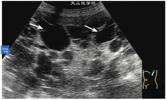 多囊肾超声图像特点：多囊肾几乎均为双肾发病，一侧多囊肾极为少见。病人一般随年龄增大而肾的体积逐渐增大，肾脏正常形态消失，肾内结构紊乱不清，肾内可见散在弥漫性分布，大小不等，形态不一的类圆形或椭圆形液性无回声囊状结构，箭头指示较大囊腔