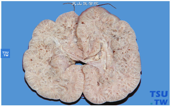 婴儿型多囊肾，剖面显示肾实质弥漫性细小、蜂窝状囊腔使肾呈海绵状