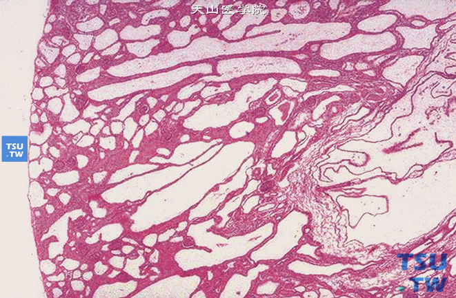 婴儿型多囊肾，镜下显示扩张的集合管
