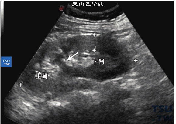 重复肾超声图像特点：重复肾系肾脏重叠故肾脏长径增大，肾窦回声也拉长，肾窦回声中有隔离征象（箭头指示），上肾和下肾肾窦回声分成两团，大多数上肾较小，下肾较大