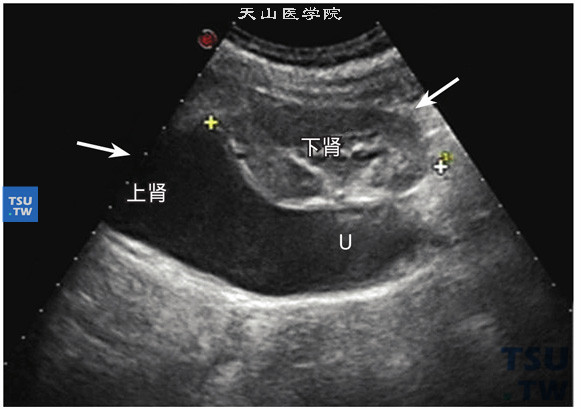 重复肾上肾积水超声图像特点：左箭头示上肾，右箭头示下肾，此病例因上肾输尿管口膨出，导致上肾重度扩张积水，肾的正常形态完全消失，上肾已无功能，呈现无回声液性区，上肾输尿管全长扩张，至输尿管下段近口处，可见囊状结构，随喷尿而大小变化。而下肾虽然体积小，但肾内结构清晰，肾内血流正常（U：输尿管）