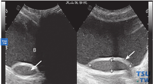 重复肾上肾输尿管口膨出超声图像特点：左右箭头提示，在不同的切面下观察输尿管口膨出图像。其特点膀胱腔内可见囊状结构，类圆形或椭圆形，表面光滑，形态规则，向膀胱腔内凸出，囊状结构位于输尿管开口处，（除输尿管异位外）体积大小变化随输尿管蠕动节律一致。大多病例合并患侧肾及输尿管积水（B：膀胱腔）