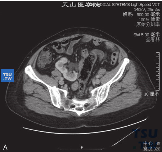 CT，肾下垂+融合肾。男，62岁，尿潜血（+）。右肾位于盆腔内右侧腰大肌旁，输尿管不短，增强后未见异常强化，同时可见左肾实质内一单纯囊肿