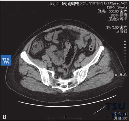 CT，肾下垂+融合肾。男，62岁，尿潜血（+）。右肾位于盆腔内右侧腰大肌旁，输尿管不短，增强后未见异常强化，同时可见左肾实质内一单纯囊肿