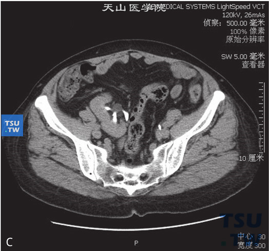 CT，肾下垂+融合肾。男，62岁，尿潜血（+）。右肾位于盆腔内右侧腰大肌旁，输尿管不短，增强后未见异常强化，同时可见左肾实质内一单纯囊肿