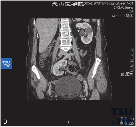 CT，肾下垂+融合肾。男，62岁，尿潜血（+）。右肾位于盆腔内右侧腰大肌旁，输尿管不短，增强后未见异常强化，同时可见左肾实质内一单纯囊肿