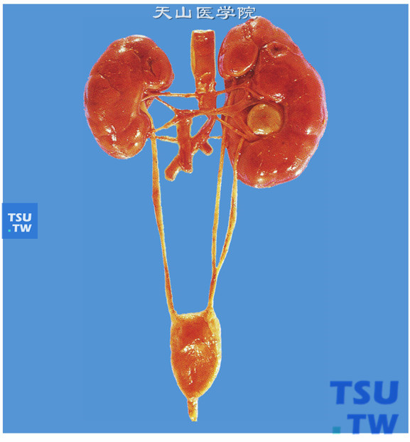 左侧重复肾，有双输尿管和未旋转的（前位的）肾盂