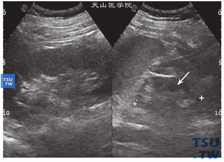 肾发育不良超声图像特点： 右图是先天性发育不良肾脏，表现肾脏体积小，患者男性，肾长6.68cm，肾实质薄，厚度不均，肾内结构不清。左图是正常肾脏超声图，由于另侧肾发育不良，健侧肾脏表现代偿性增大，实质增厚，肾内结构正常，肾长12.9cm，实质厚度2.5cm