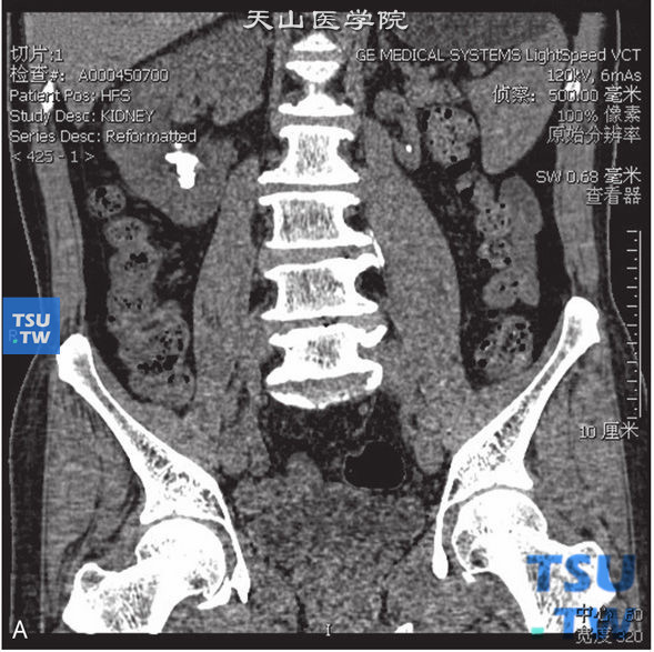 CT，左肾发育不良，女，49岁，肾结石。左肾体积较对侧小，形态正常。双肾下盏分别见结石