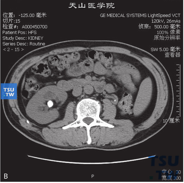 CT，左肾发育不良，女，49岁，肾结石。左肾体积较对侧小，形态正常。双肾下盏分别见结石