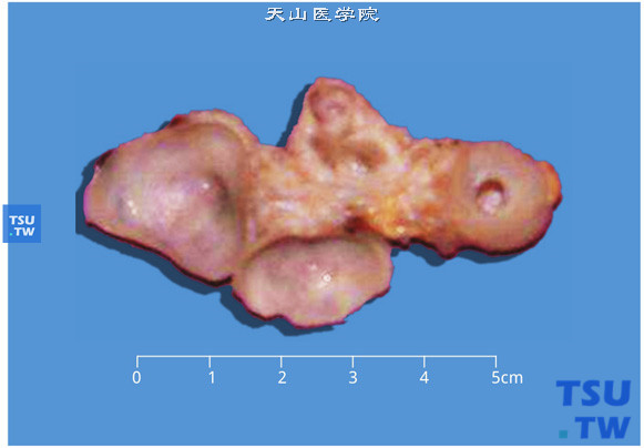 肾发育不良（dysplasia），剖面显示肾多发性囊肿，未见肾实质