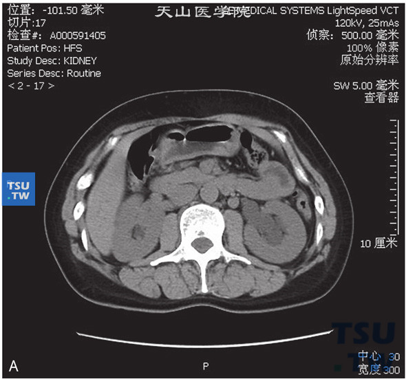 图1：CT，肾盂旁囊肿，女，44岁，肾积水；左侧肾窦内见囊状水样密度灶，边缘清晰，增强后未见明显强化，分泌期可见肾盂、肾盏对比剂充盈，肾窦内囊状水样密度灶内未见对比剂进入