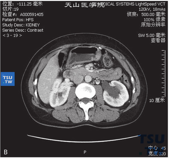 图2：图1：CT，肾盂旁囊肿，女，44岁，肾积水；左侧肾窦内见囊状水样密度灶，边缘清晰，增强后未见明显强化，分泌期可见肾盂、肾盏对比剂充盈，肾窦内囊状水样密度灶内未见对比剂进入