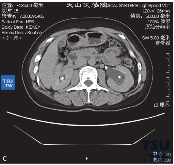 图3：图1：CT，肾盂旁囊肿，女，44岁，肾积水；左侧肾窦内见囊状水样密度灶，边缘清晰，增强后未见明显强化，分泌期可见肾盂、肾盏对比剂充盈，肾窦内囊状水样密度灶内未见对比剂进入