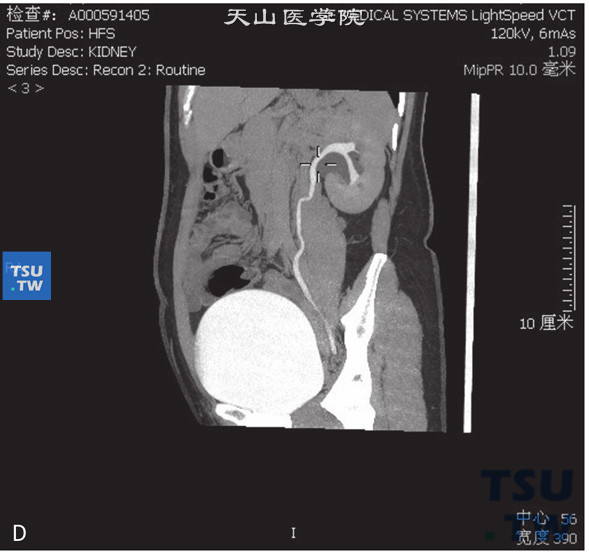 图4：图1：CT，肾盂旁囊肿，女，44岁，肾积水；左侧肾窦内见囊状水样密度灶，边缘清晰，增强后未见明显强化，分泌期可见肾盂、肾盏对比剂充盈，肾窦内囊状水样密度灶内未见对比剂进入