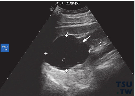 B超：单纯性肾囊肿超声图像特点：肾囊肿大多呈圆形、类圆形或椭圆形的规则形态，少数也可呈不规则形。囊内为无回声液性暗区，囊壁薄而光滑。透声性良好，囊肿后方回声增强。由于囊肿的大小和发生位置的不同，可以引起肾形态的不同改变，囊肿较小对肾大小、形态和结构可以毫无影响，也可以因囊肿过大使肾脏受压变形异位甚至肾积水。箭头提示肾上极囊肿（C：囊肿）