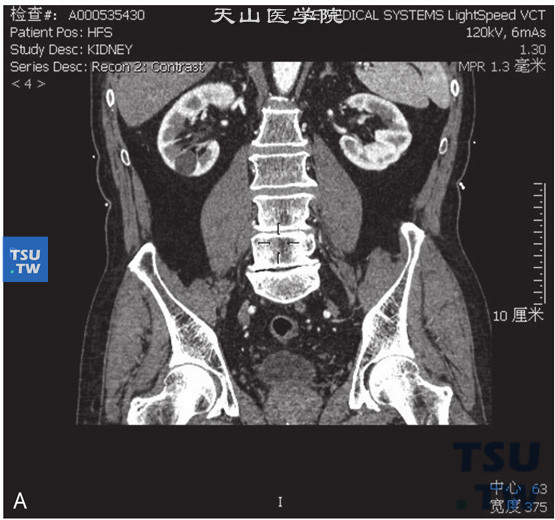 肾囊肿Bosniak Ⅰ 图A