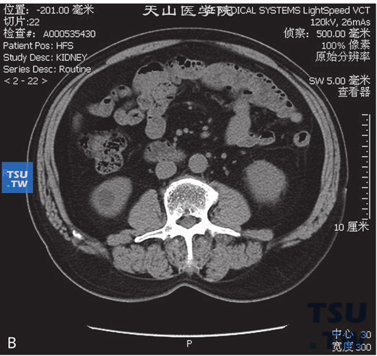 肾囊肿Bosniak Ⅰ图B