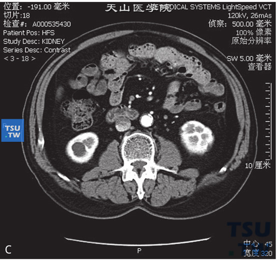 肾囊肿Bosniak Ⅰ 图C