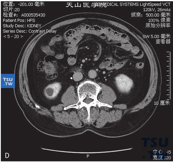 肾囊肿Bosniak Ⅰ图D