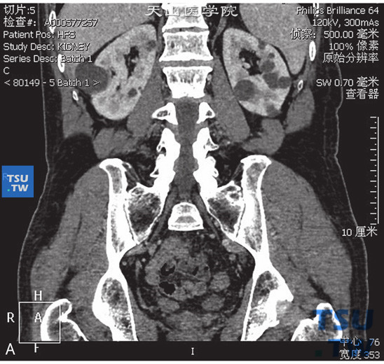 图A：肾囊肿Bosniak Ⅱ，右肾门水平肾实质内见以囊状水样密度灶，边缘清晰，其内见少量含钙化结节的细分隔，增强后未见明显强化，未见壁结节