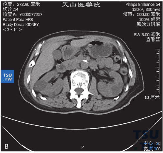 图B：肾囊肿Bosniak Ⅱ，右肾门水平肾实质内见以囊状水样密度灶，边缘清晰，其内见少量含钙化结节的细分隔，增强后未见明显强化，未见壁结节
