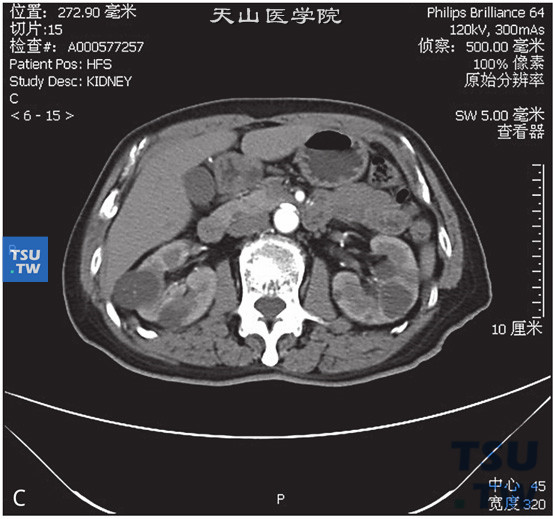 图B：肾囊肿Bosniak Ⅱ，右肾门水平肾实质内见以囊状水样密度灶，边缘清晰，其内见少量含钙化结节的细分隔，增强后未见明显强化，未见壁结节