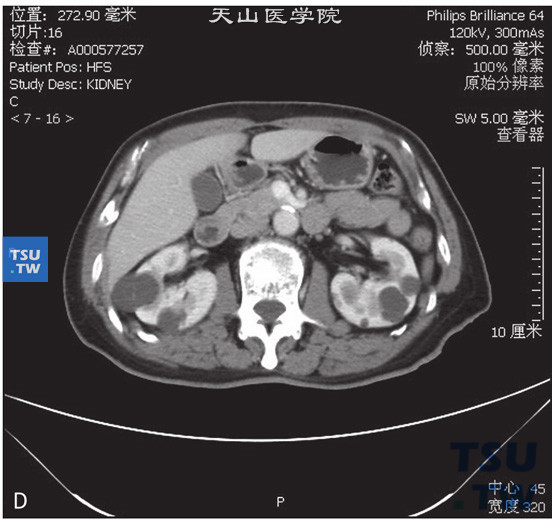图D：肾囊肿Bosniak Ⅱ，右肾门水平肾实质内见以囊状水样密度灶，边缘清晰，其内见少量含钙化结节的细分隔，增强后未见明显强化，未见壁结节