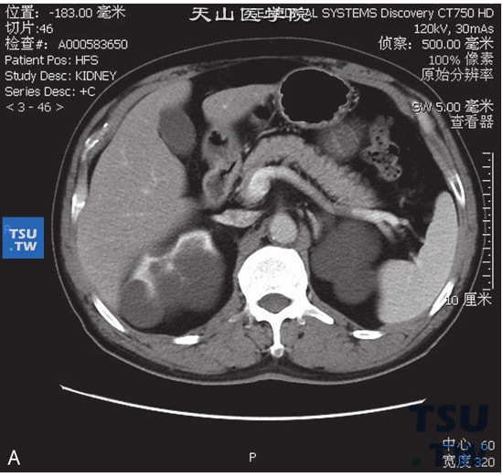 图A：肾囊肿Bosniak Ⅱf，右肾上极见囊状水样密度灶，边缘清晰，其内见以稍粗分隔，增强后可见轻度增强，未见壁结节