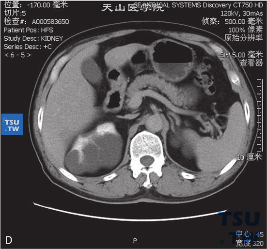 图D：肾囊肿Bosniak Ⅱf，右肾上极见囊状水样密度灶，边缘清晰，其内见以稍粗分隔，增强后可见轻度增强，未见壁结节