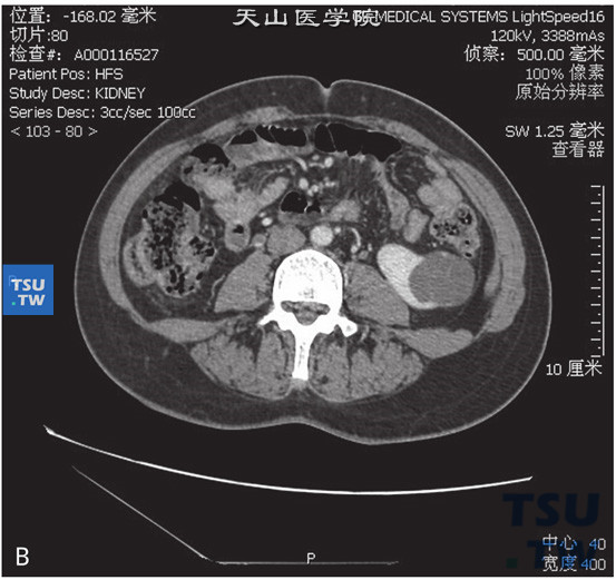 图B：肾囊肿 Bosniak Ⅲ左肾下极见一囊状水样密度灶，边缘清晰，增强后可见囊内多发分隔，囊性灶前壁见小结节状软组织密度灶，局部囊壁未见增厚