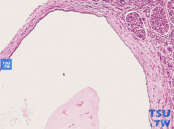单纯性肾囊肿，被覆单层扁平上皮细胞，囊壁纤维化