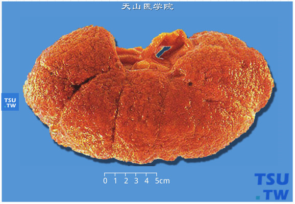 高血压伴发的良性肾硬化