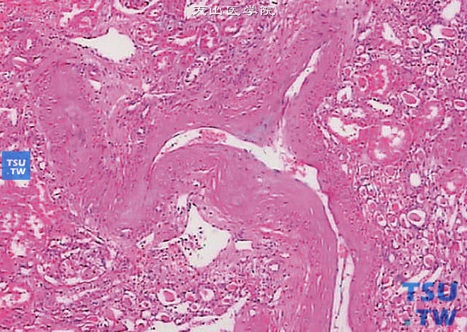 良性肾小动脉硬化症（良性肾硬化）。肾动脉内膜及肌层增厚伴黏液变性，管腔不规则