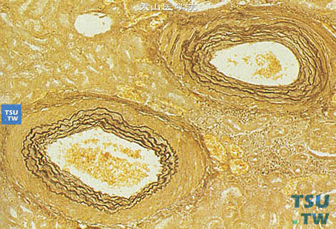 恶性肾硬化（Elatic Van Gieson染色），小叶间动脉内弹力板的弹力纤维呈向心性层状增生，内膜水肿性增厚