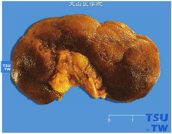 肾动脉狭窄之原发性颗粒固缩肾（大体）