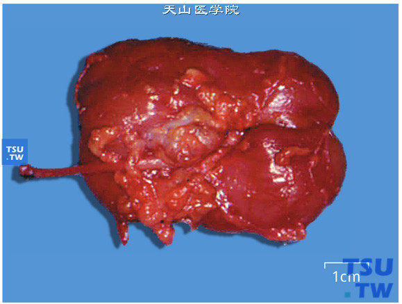 肾动脉狭窄（大体），肾门处可见动脉瘤