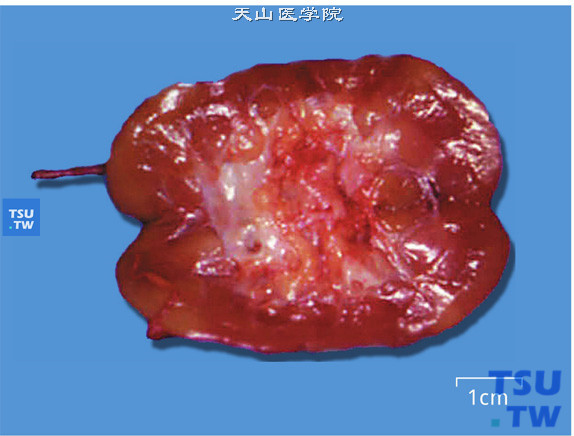 肾动脉狭窄（切面），可见中极肾皮质缺血