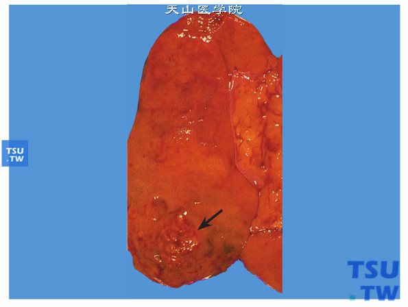 腎炎 急性 腎盂 膀胱炎と急性腎盂腎炎