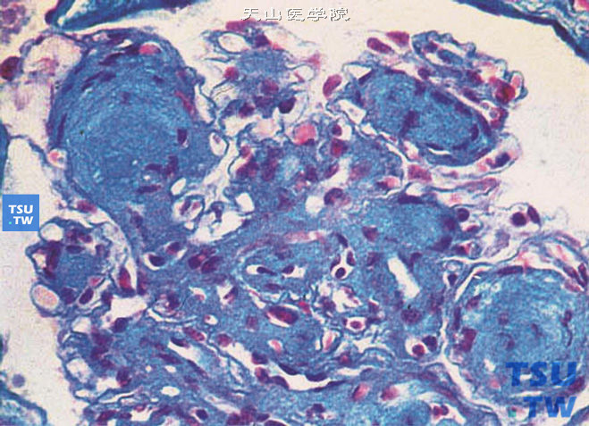 糖尿病性结节性肾小球硬化症，Masson染色，肾小球毛细血管袢间及系膜处可见由蓝染物形成的结节，周边有残存的毛细血管