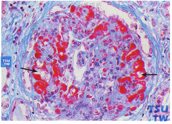 糖尿病性结节性肾小球硬化症，Masson染色，球丛毛细血管袢上有纤维素样血浆物质渗入，呈半月状沉积——纤维素帽